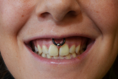 12g Smiley Healed