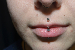 Vertical-Lip-Healed