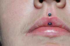 Vertical-Philtrum-Fresh