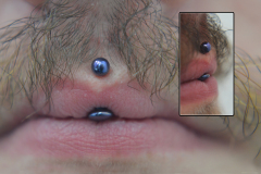 Vertical-Philtrum